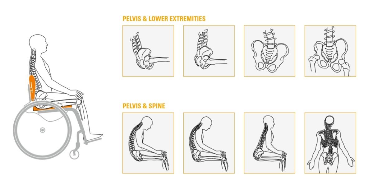 How to really assess lumbar lordosis - Dispelling the myth of anterior  pelvic tilt - MSK Neurology